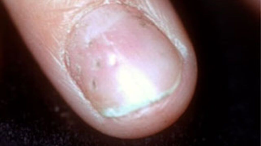  Uña con 'pits' ungueales