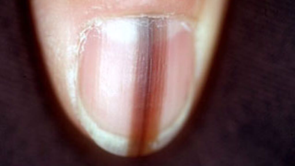  Uña con una línea marrón