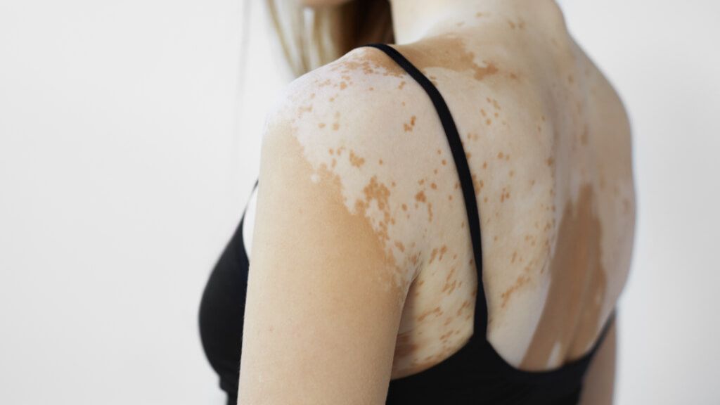 Mujer con vitíligo