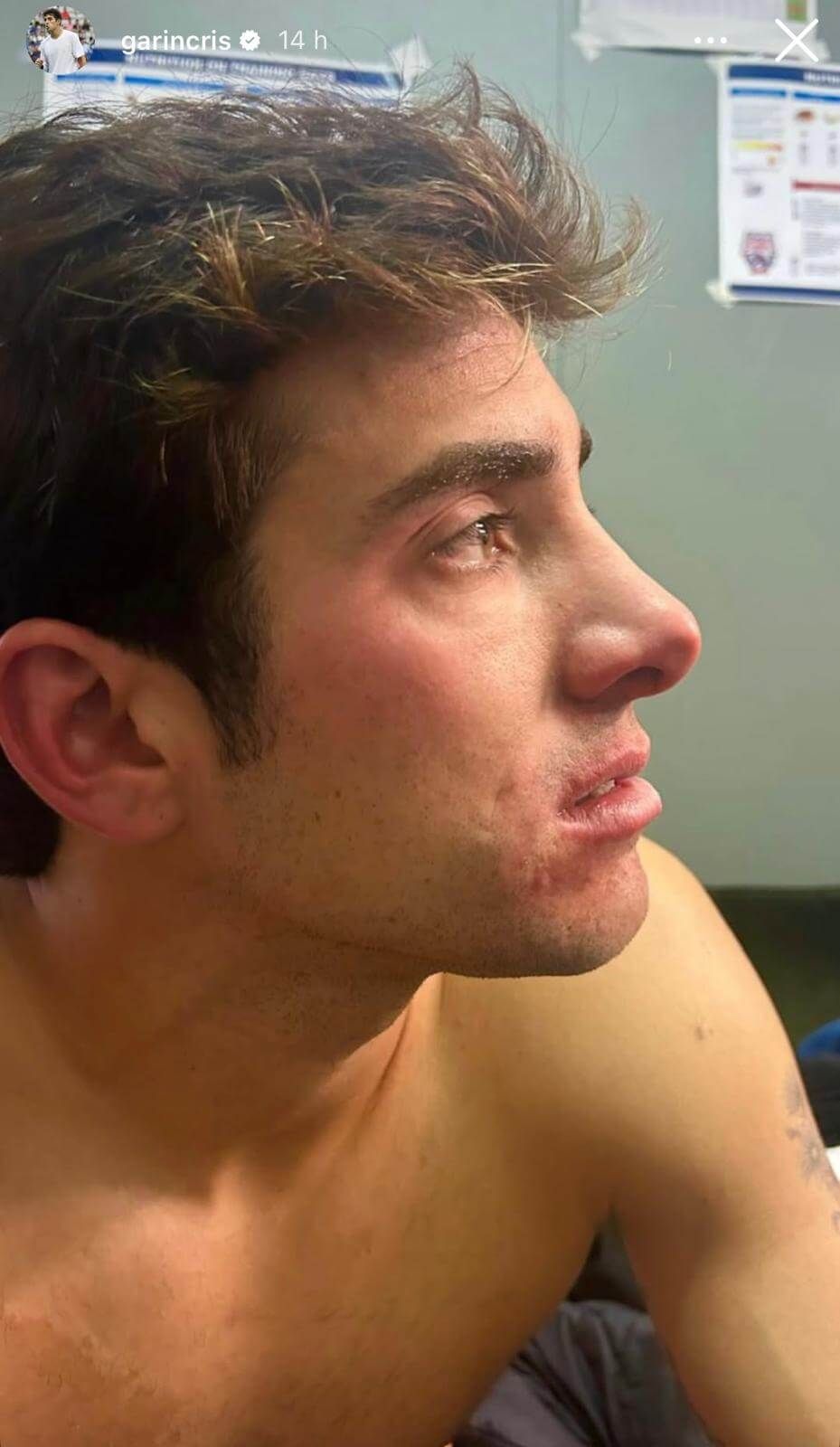  Cristian Garín muestra su cara tras el accidente (FOTO: Instagram).