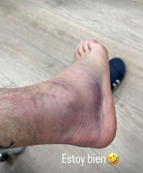  El tobillo de Aitor Ruibal.