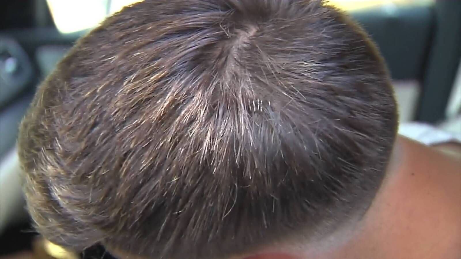  Miranda muestra a ElDesmarque los puntos en su cabeza.