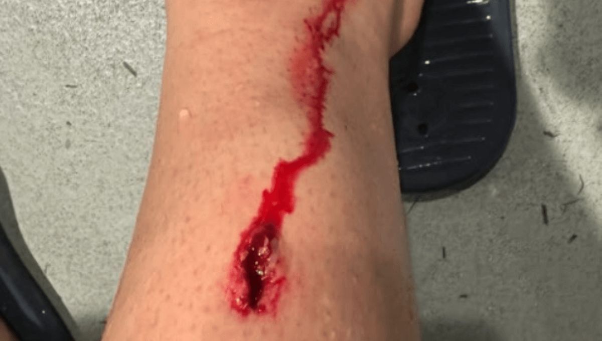  Herida de Beñat Prados en su pierna.