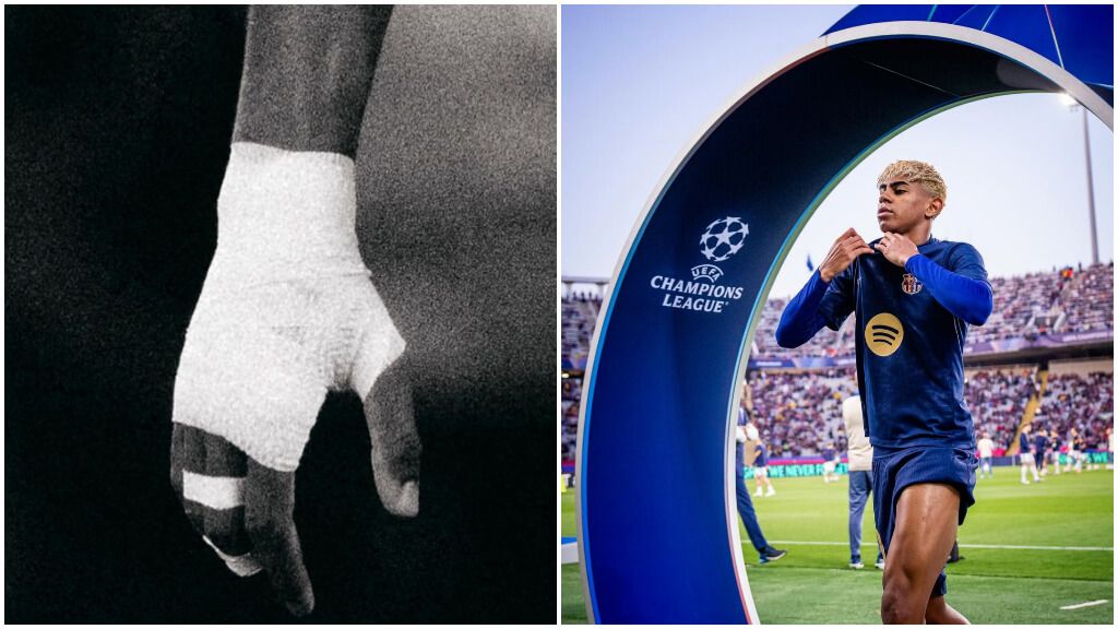  Lamine Yamal mostró su mano vendada en el Barcelona-Inter en sus redes (fotos: Instagram Lamine).