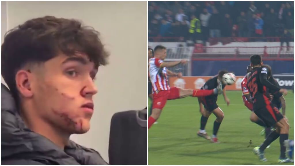  Pau Cubarsí y una patada que da miedo verla: así quedó su rostro