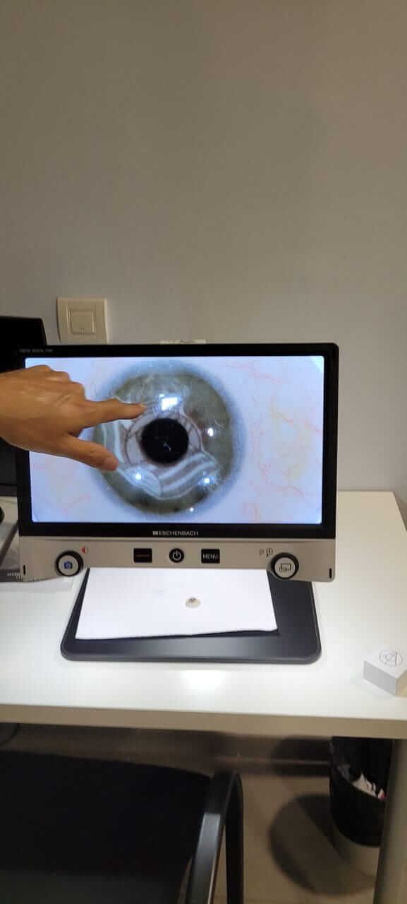  Diseño de la prótesis ocular de Jesús Ruiz. La foto está hecha a través de una lupa electróni