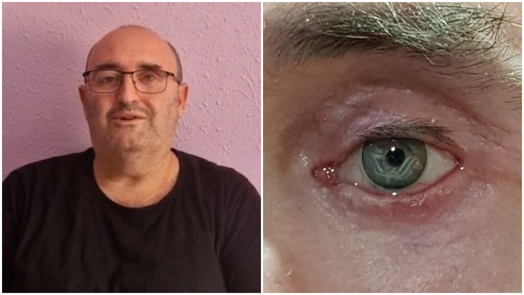  Jesús Ruiz, aficionado txuri urdin que lleva el escudo de la Real Sociedad en una prótesis ocular.