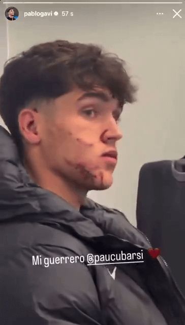  Gavi muestra como quedó la cara de Pau Cubarsí