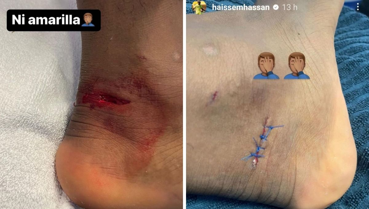 La herida de Haissem Hassan.