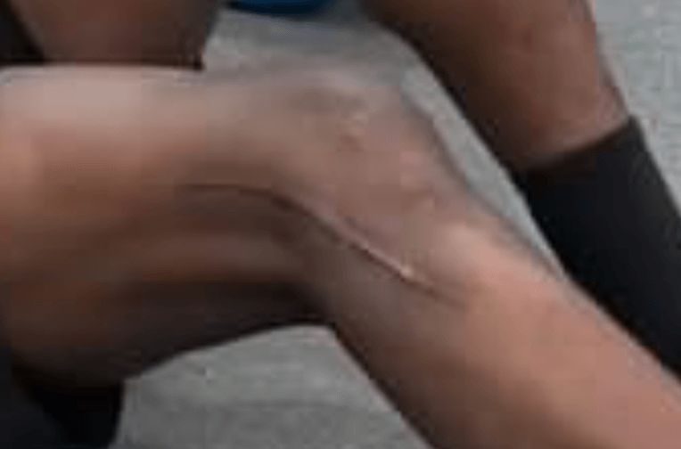  La cicatriz en la rodilla de Mouctar Diakhaby.