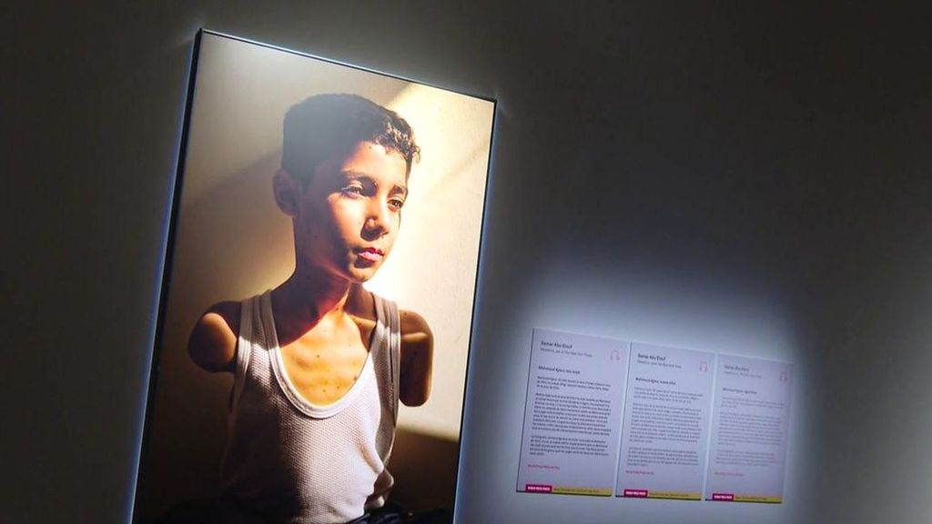 Lo mejor del World Press Photo en Barcelona: Impacta Mahmoud Ajjour , palestino de 9 años, mutilado