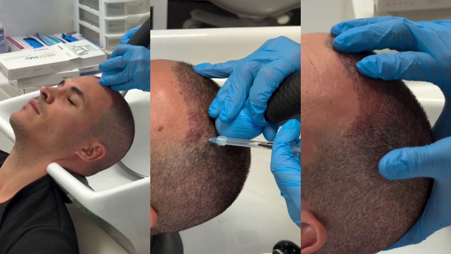 Kiko Jiménez se ha sometido a un nuevo procedimiento capilar para frenar la caída del cabello