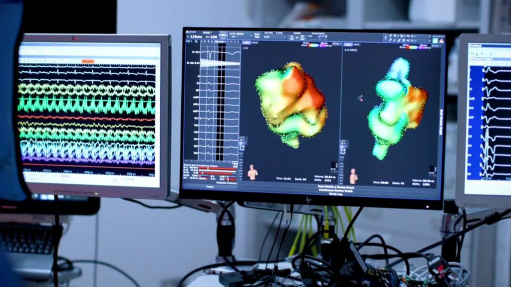 Demuestran que los betabloqueantes no aportan beneficios en pacientes sin daños tras un infarto