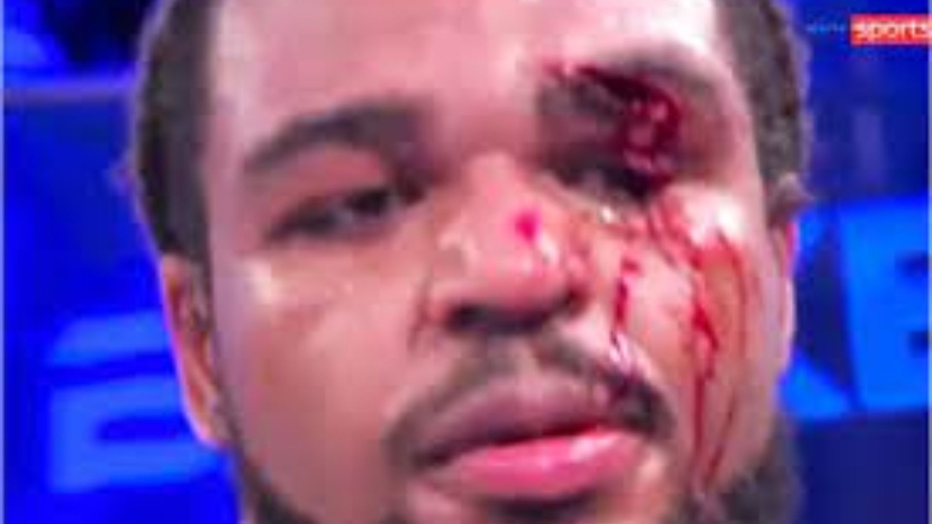 desfiguran_la_cara_a_jeamie_tshikeva_sufre_una_tremenda_lesion_en_el_ojo_y_tendra_que_.jpg desfiguran_la_cara_a_jeamie_tshikeva_sufre_una_tremenda_lesion_en_el_ojo_y_tendra_que_.jpg