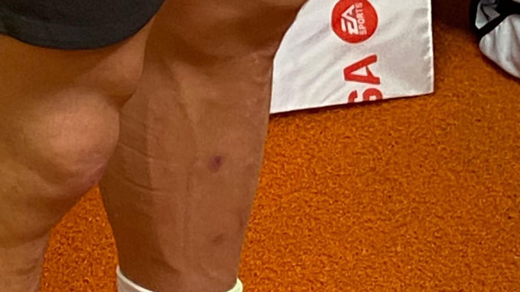 Así ha quedado el tobillo de Pepelu tras la entrada de Robert Navarro en el Valencia-Cádiz