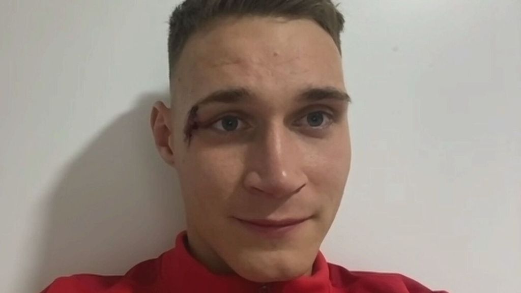 Franky, el héroe del Barbastro que eliminó al Almería una brecha en la cara: “Llevo seis grapas, pero no hay dolor”