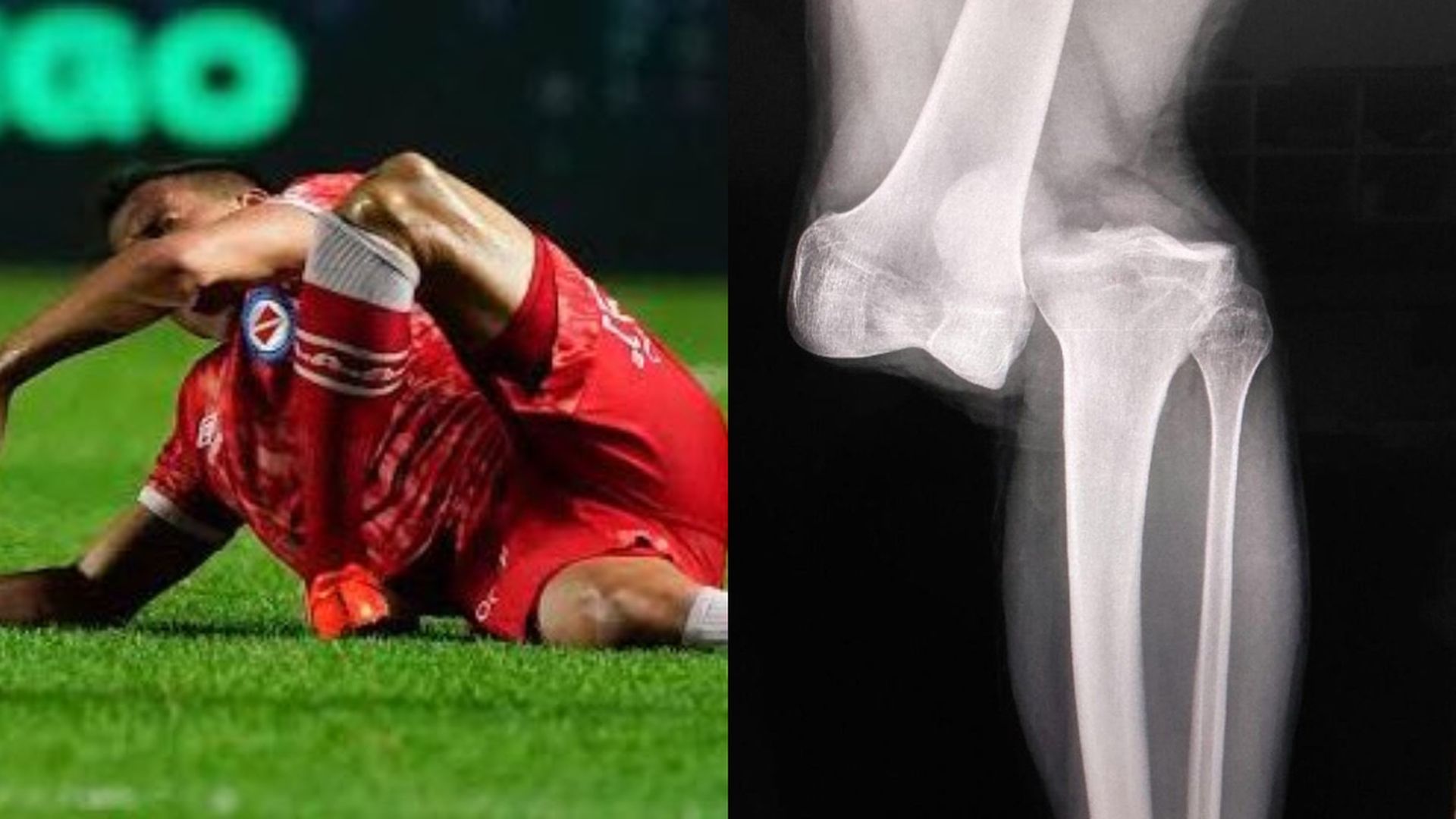 la_radiografia_de_la_rodilla_de_luciano_sanchez_despues_del_pisoton_de_marcelo.jpg la_radiografia_de_la_rodilla_de_luciano_sanchez_despues_del_pisoton_de_marcelo.jpg