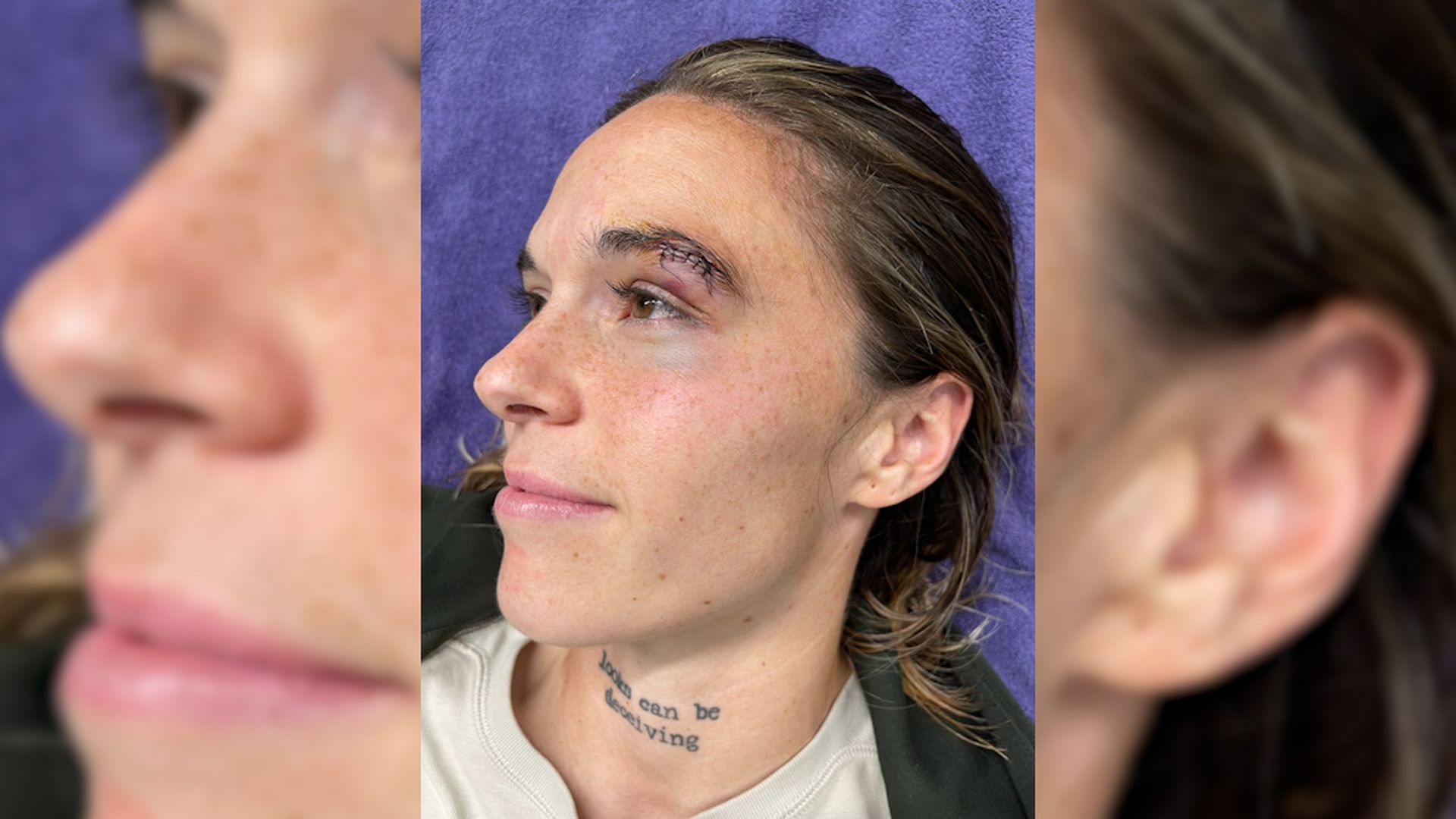 mapi_leon_ensena_su_herida_en_redes_sociales_fuente__mapileon16.png mapi_leon_ensena_su_herida_en_redes_sociales_fuente__mapileon16.png