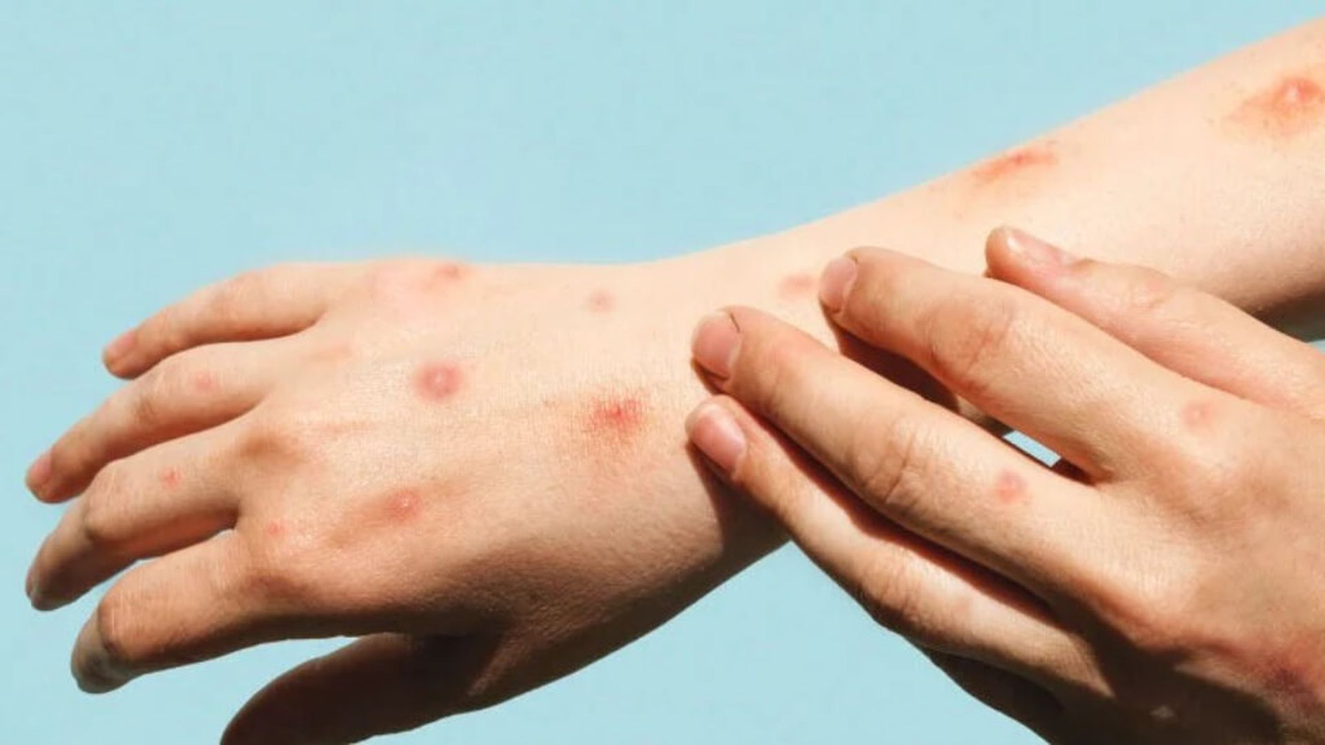 mpox_viruela_monojpg_001.jpg mpox_viruela_monojpg_001.jpg