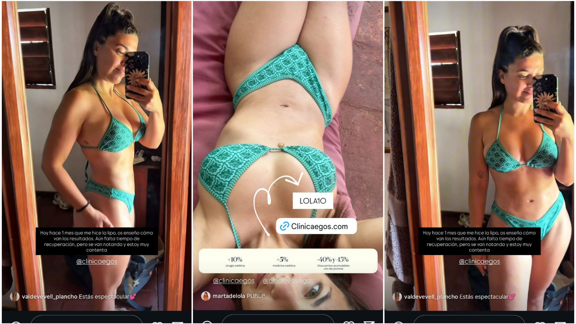 Lola Mencía posa en bikini y muestra su cuerpo un mes después de su segunda liposucción