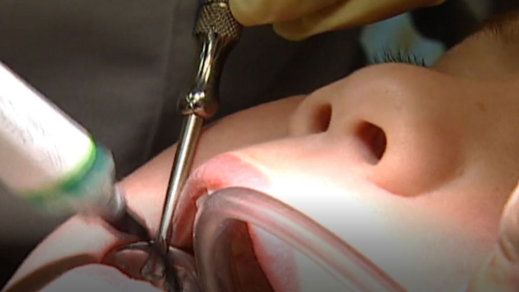 Qué es la sedación endovenosa, el tratamiento recibido por la niña que murió en Alzira