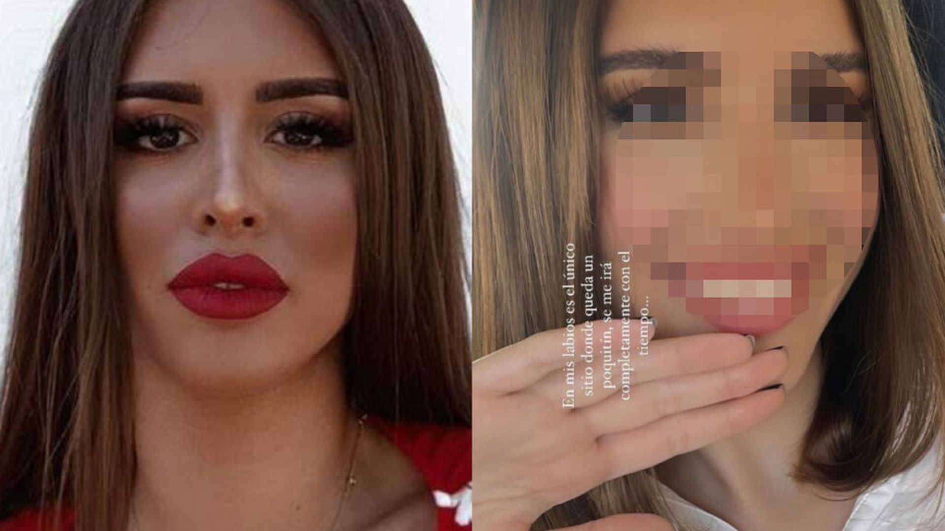 El antes y el después de Marina tras retirarse todos los retoques estéticos del rostro