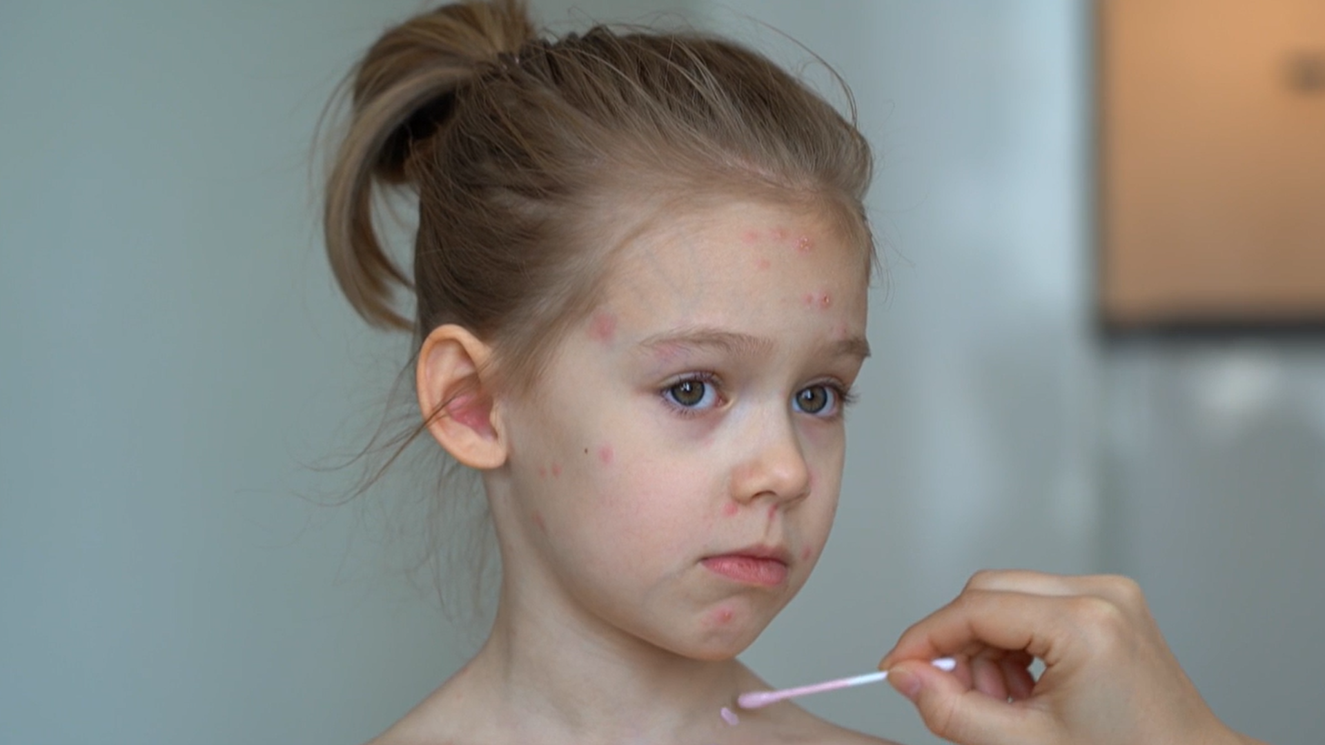 Niña con sarampión Niña con sarampión