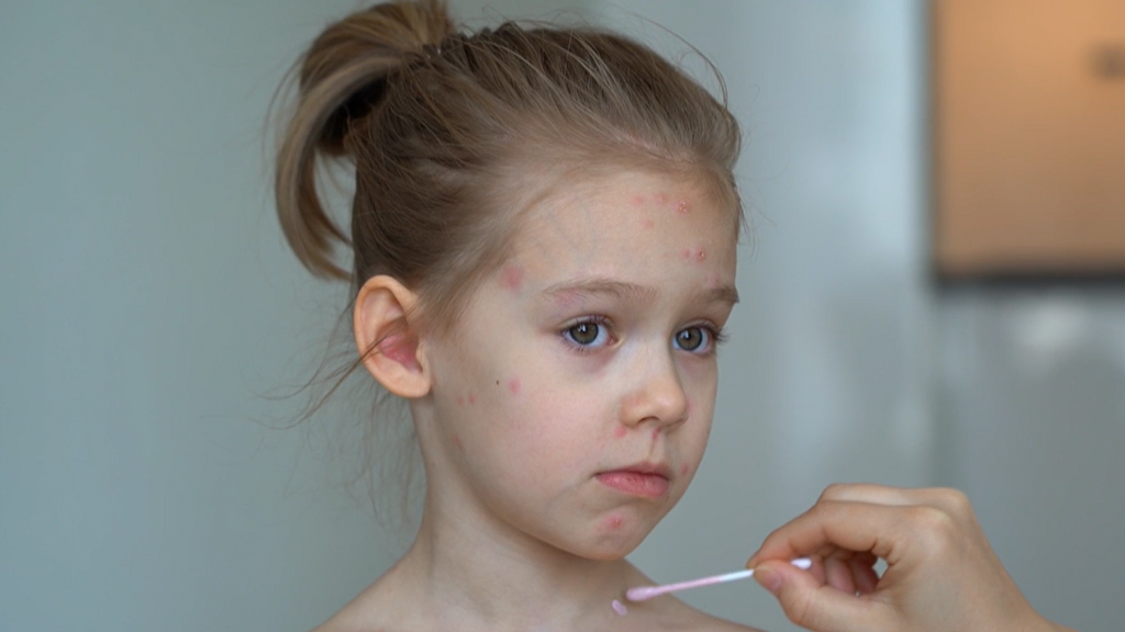 El sarampión resurge en el mundo: los casos superan niveles previos a la pandemia