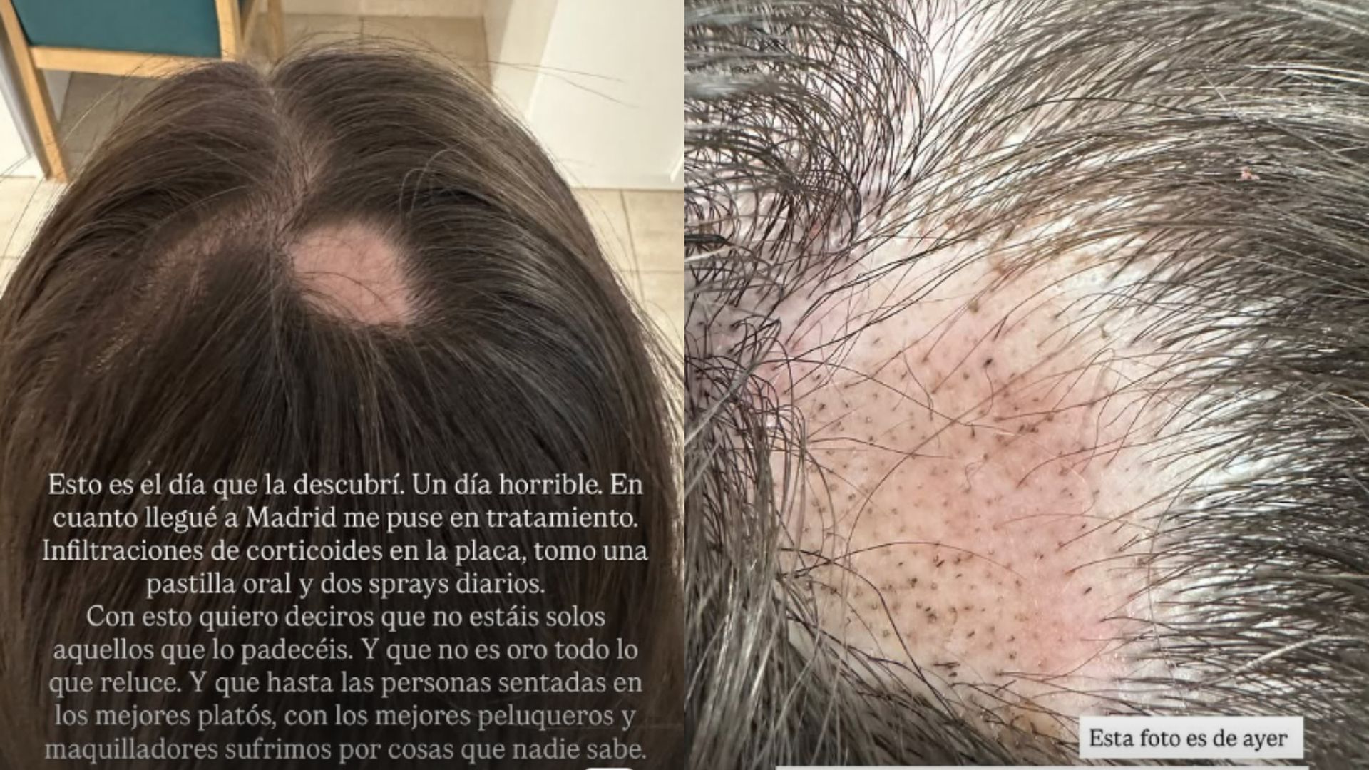 Alexia Rivas visibiliza la alopecia areata