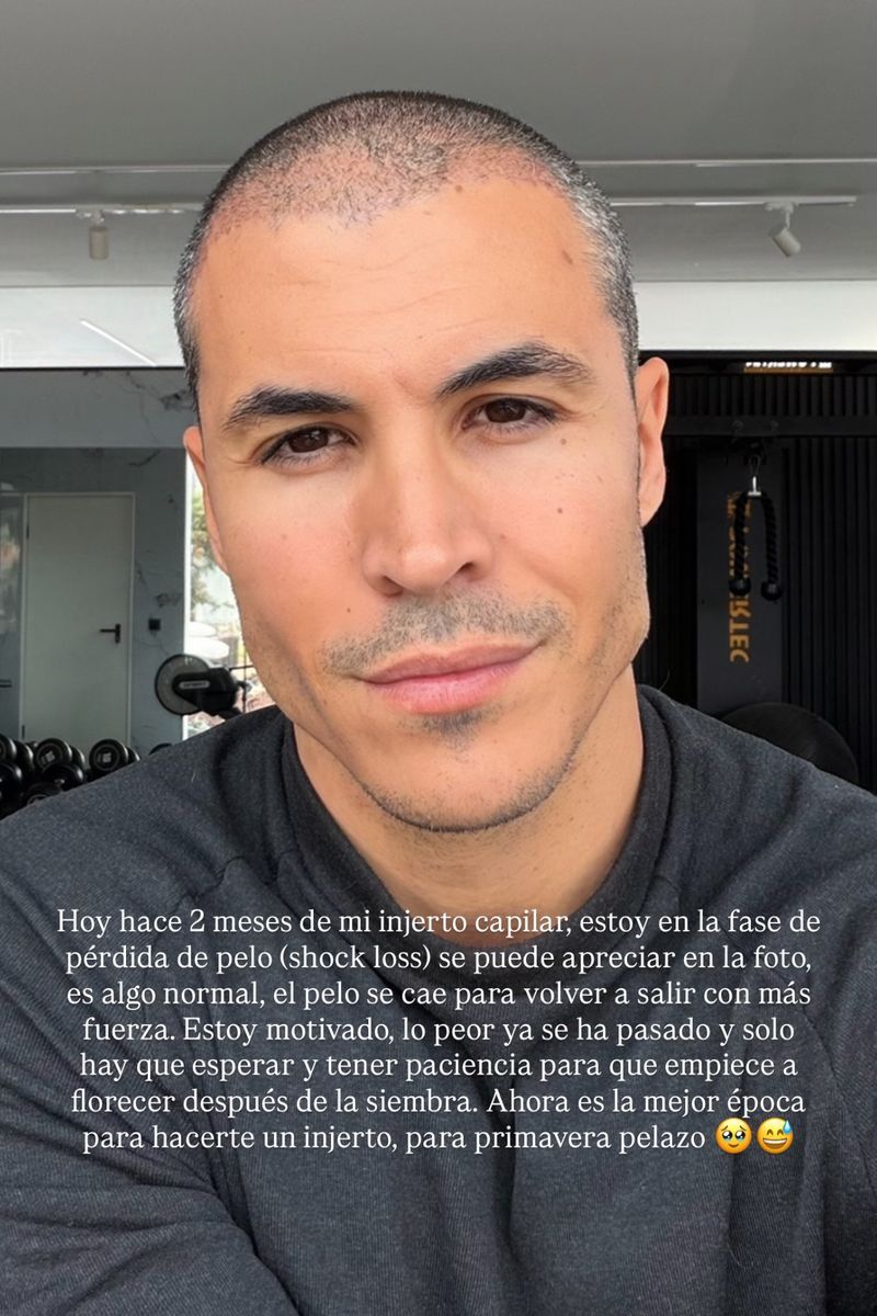 Kiko Jiménez posa en la fase de pérdida de pelo tras su injerto
