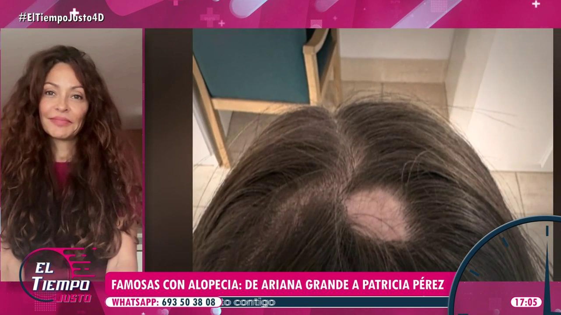 Patricia Pérez nos da las claves sobre la alopecia areata, tras el testimonio de Alexia Rivas