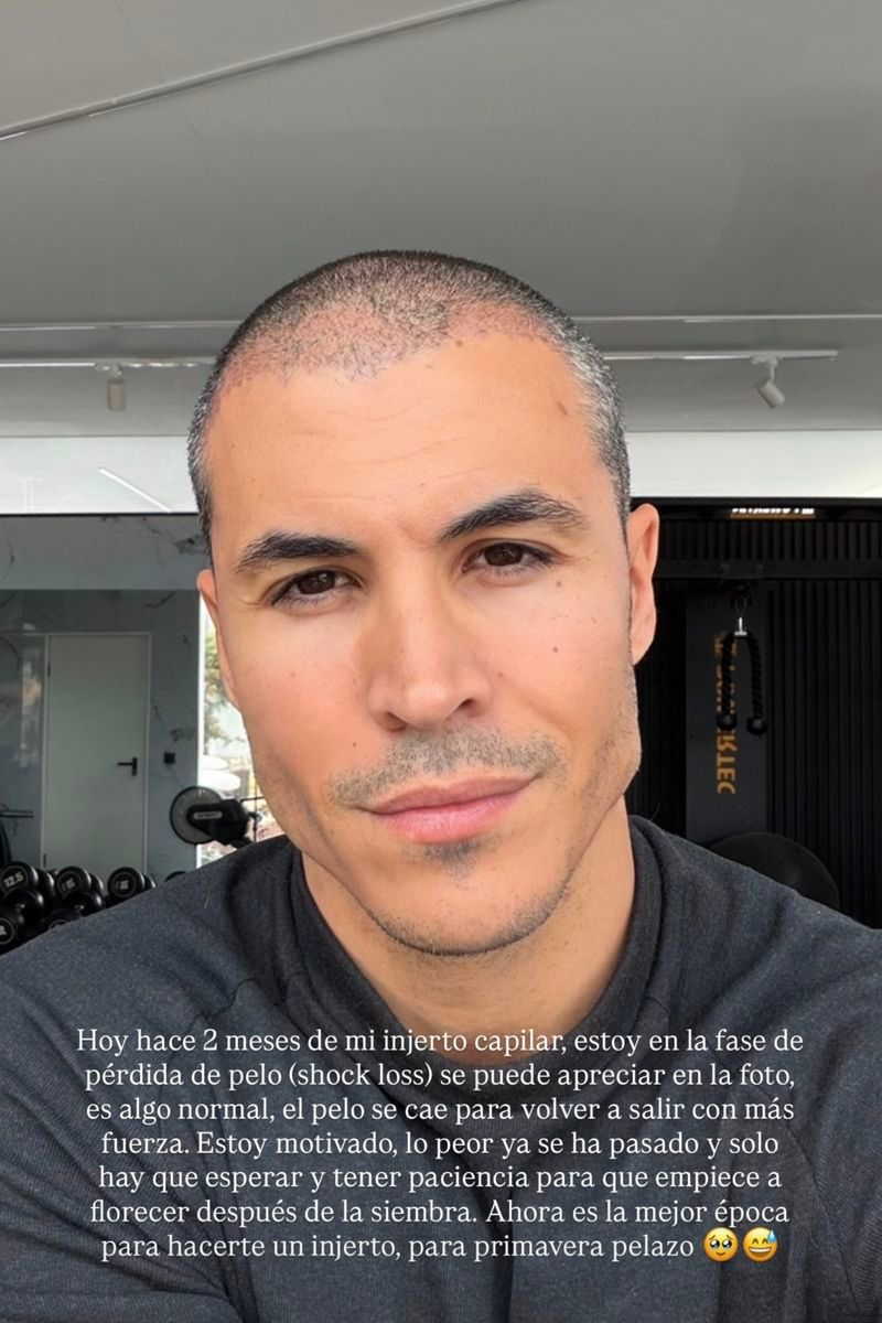 Kiko Jiménez muestra el estado de su pelo tras sufrir shock loss después del injerto