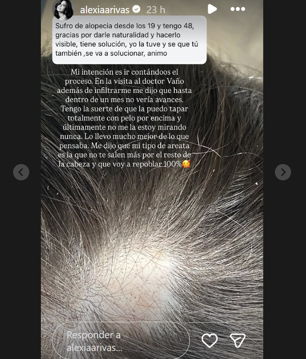 Alexia Rivas muestra la evolución de su alopecia