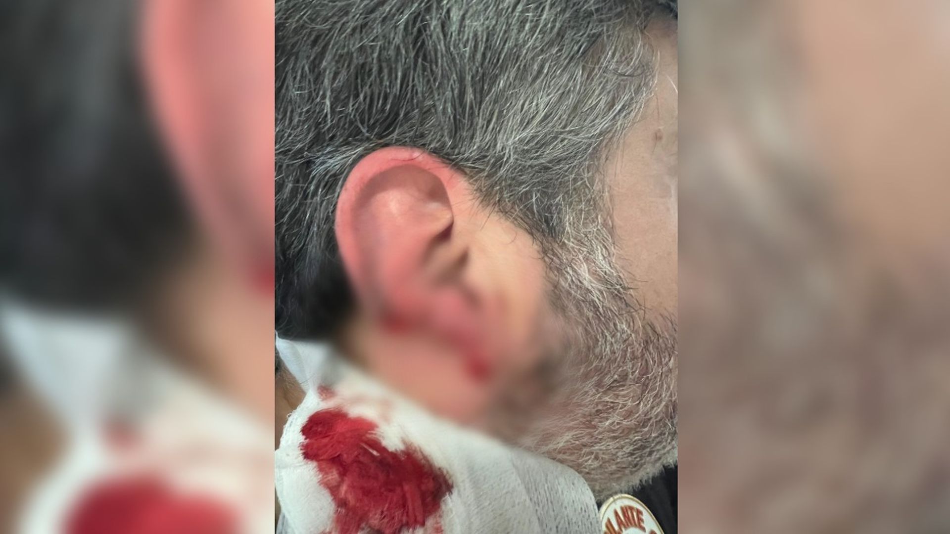 Arranca parte de un oreja de un vigilante de seguridad en un hospital gallego