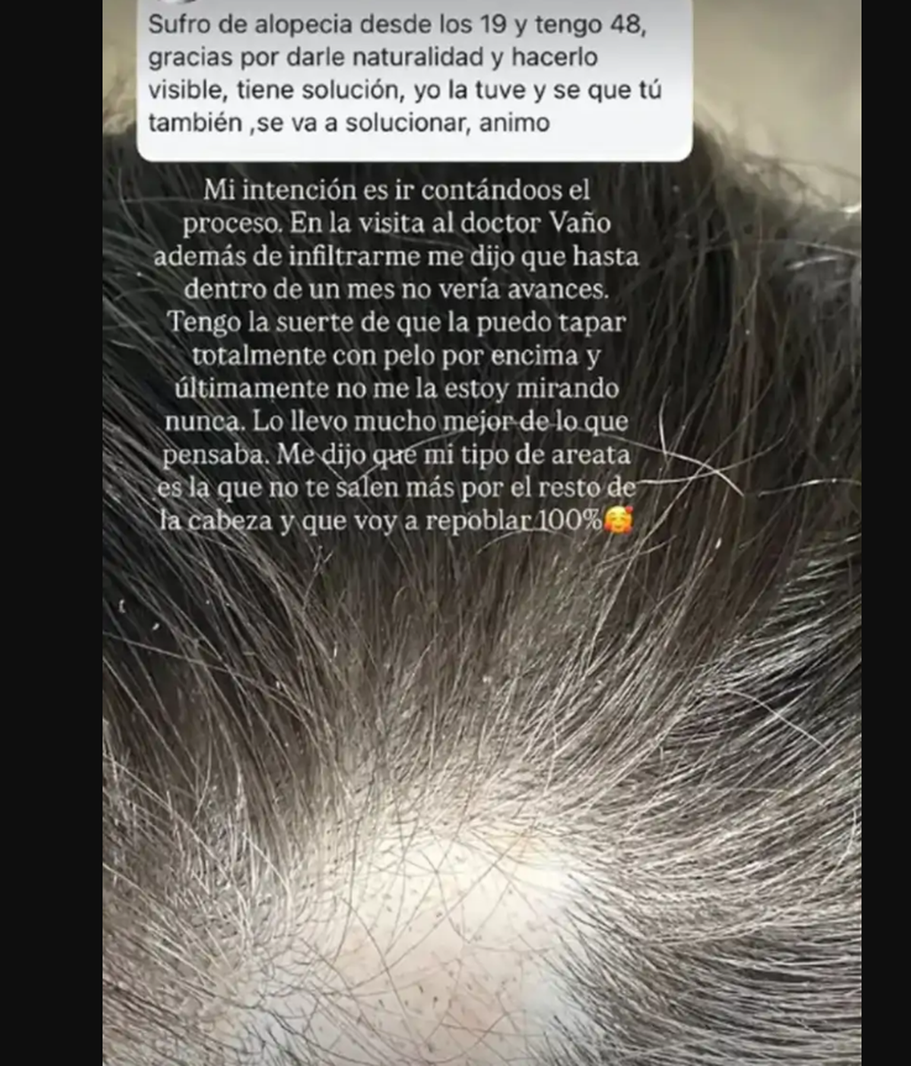 La alopecia de Alexia Rivas
