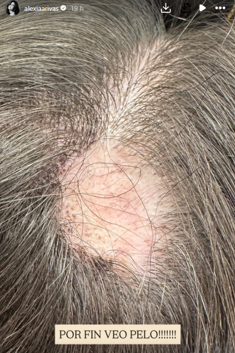 Alexia Rivas ha mostrado la última foto de su calva en la cabeza tras iniciar el tratamiento para la alopecia