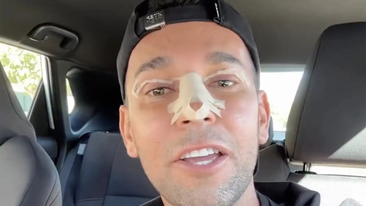 Omar Sánchez tras su rinoplastia