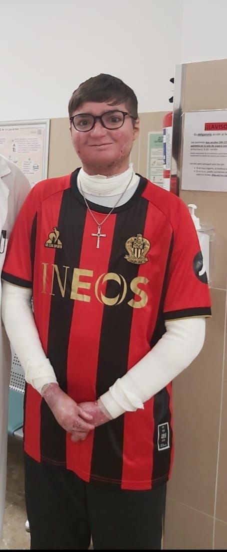 Adrián, joven malagueño con piel de mariposa