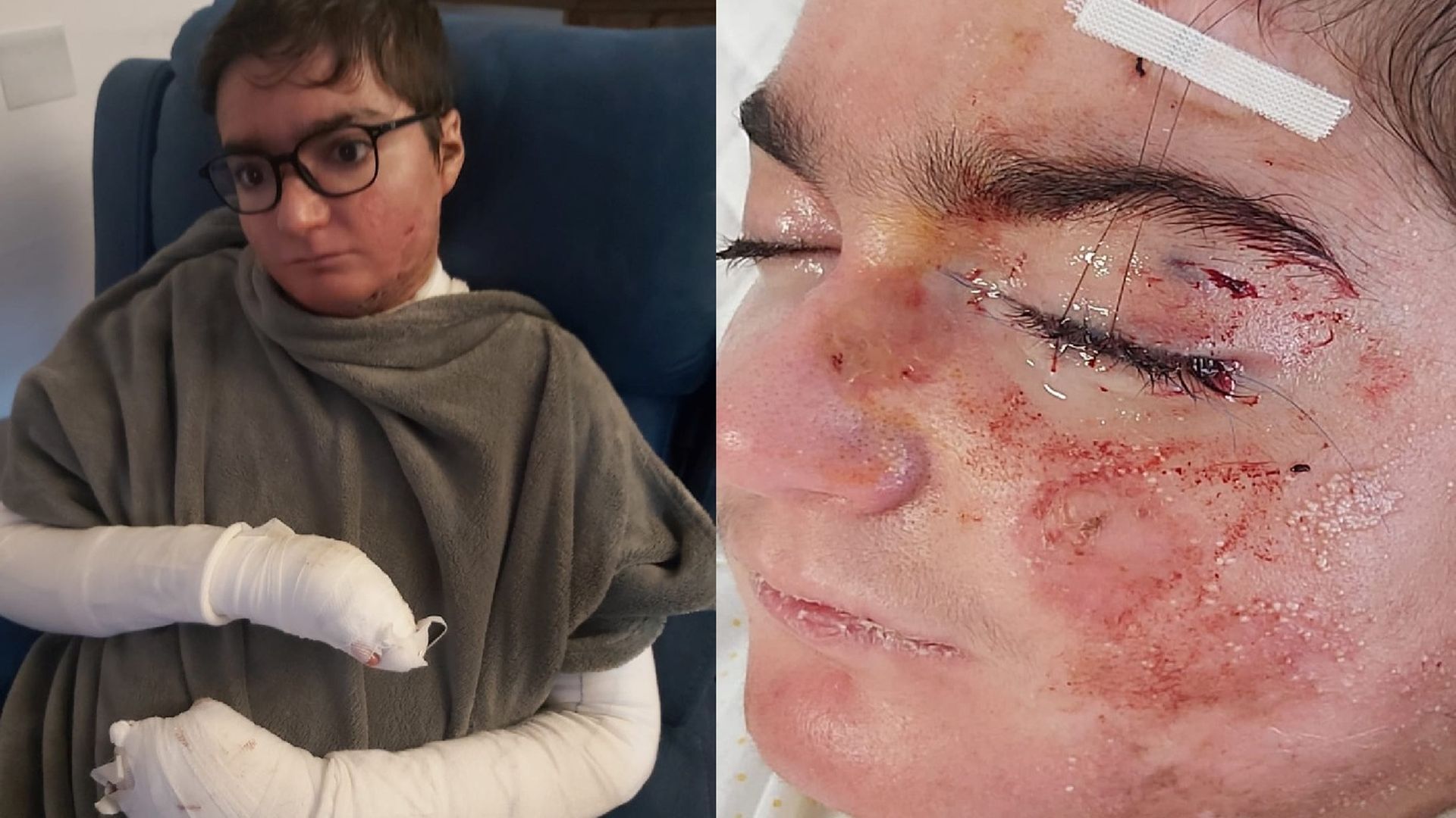 Adrián, un niño malagueño con la enfermedad piel de mariposa Adrián, un niño malagueño con la enfermedad piel de mariposa