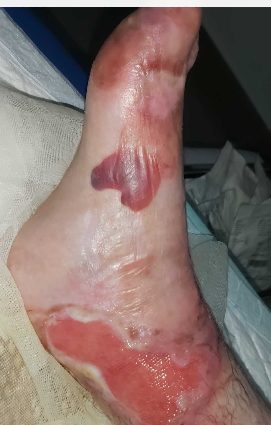 Un pie de Adrián, con heridas por la enfermedad