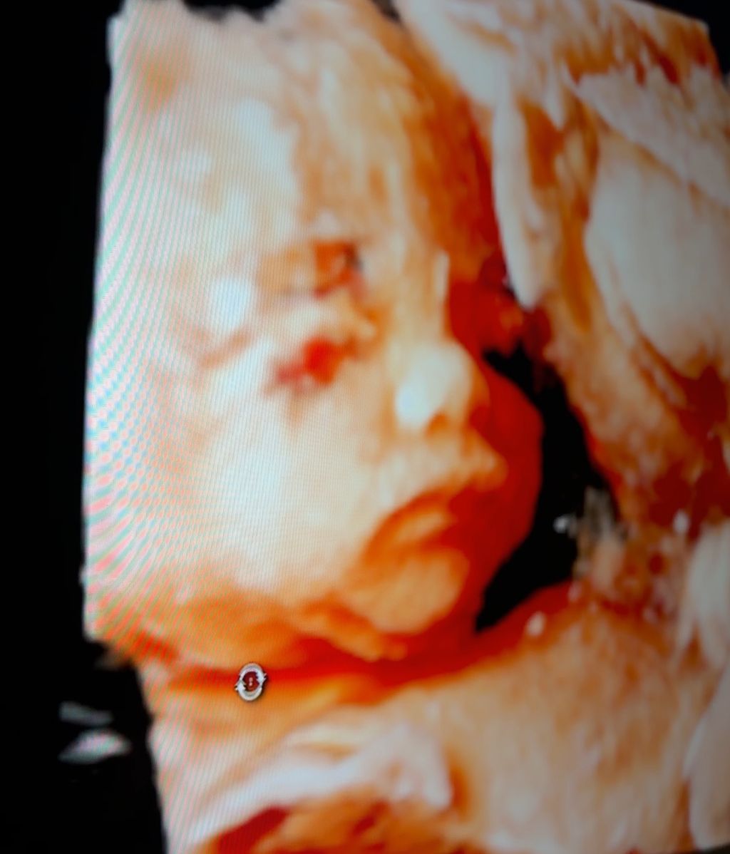 Rodri Fuertes y Marta Castro presentan a su hija en la semana 26 de gestación