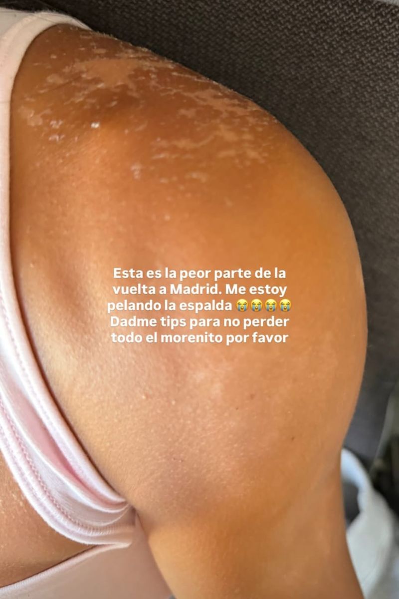 Sofía muestra el problema de piel tras su viaje a Maldivas