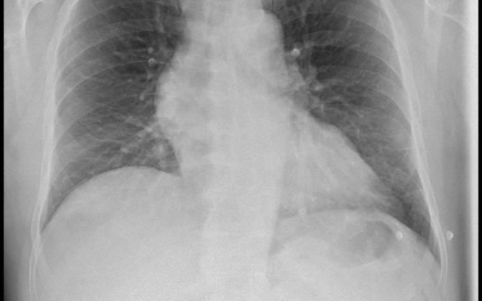 Radiografía paciente fallecido