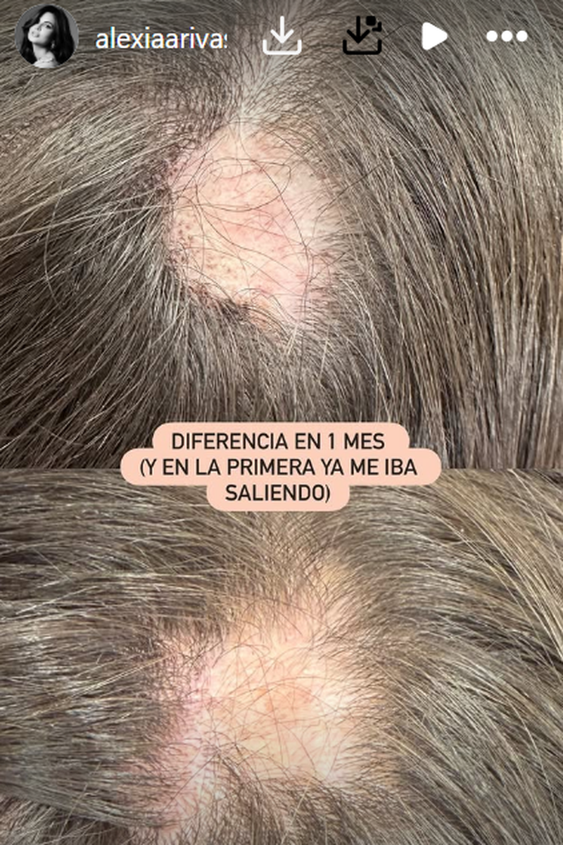 Alexia Rivas ha compartido una foto del estado de su calva del pasado mes de octubre