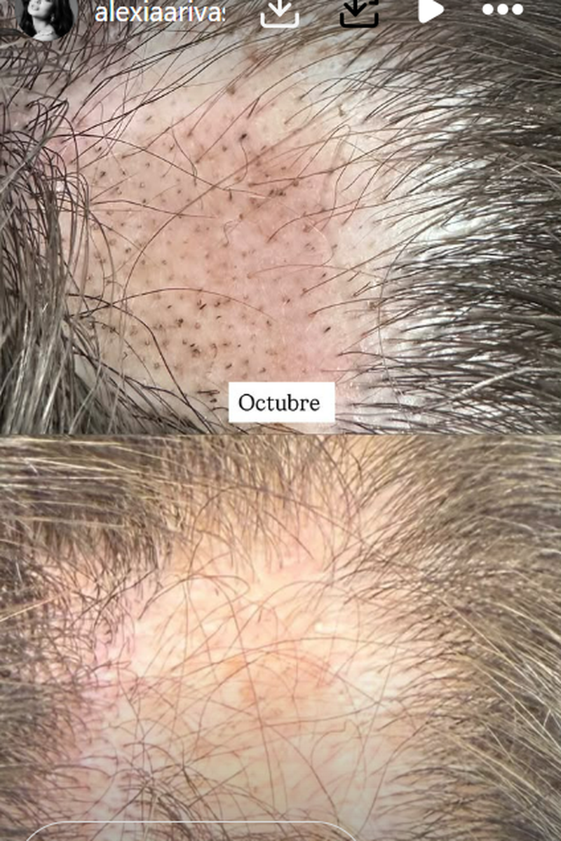 Alexia Rivas, orgullosa, muestra el resultado de su tratamiento contra la alopecia areata