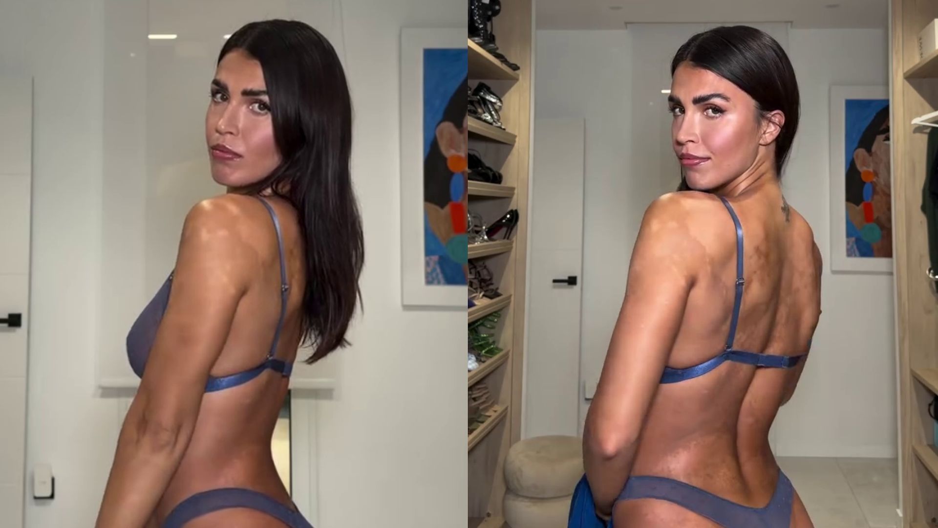 Sofía Suescun enseña las manchas de su piel