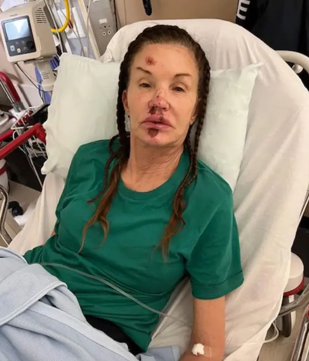 Janice Dickinson comparte sus fotos tras la caída