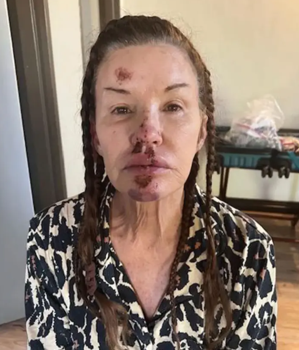 Janice Dickinson comparte sus fotos tras la caída