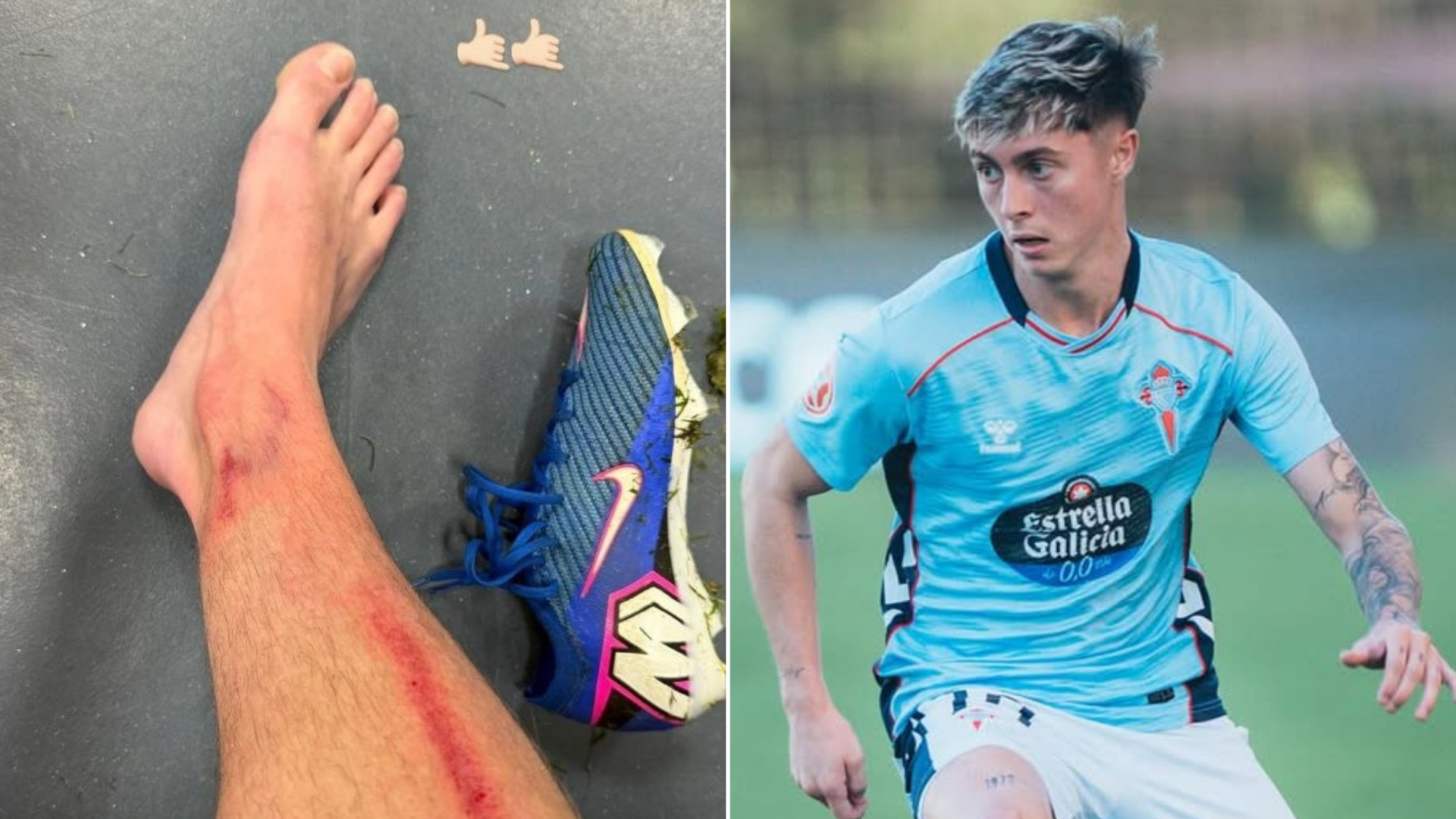 Óscar Marcos muestra su pierna tras la entrada de Merchán Óscar Marcos muestra su pierna tras la entrada de Merchán