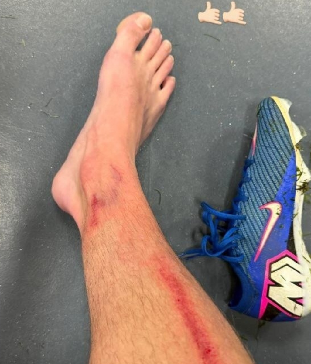 Óscar Marcos muestra su pierna tras la entrada de Merchán